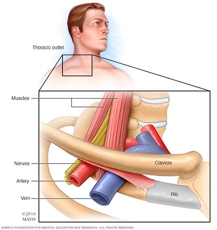 thoracic outlet symptoms CA