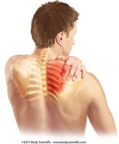 thoracic outlet syndrome treatment Encino