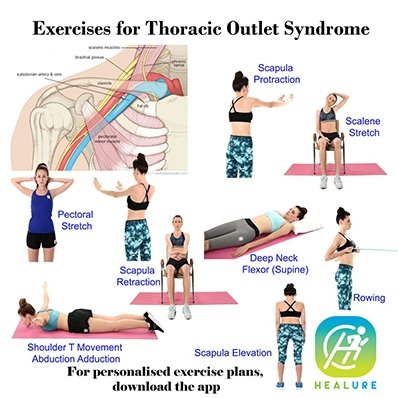 thoracic outlet syndrome exercise