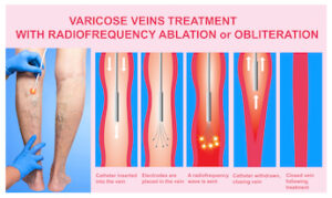 Varicose Veins Treatment