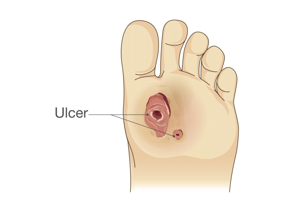 Ulceration