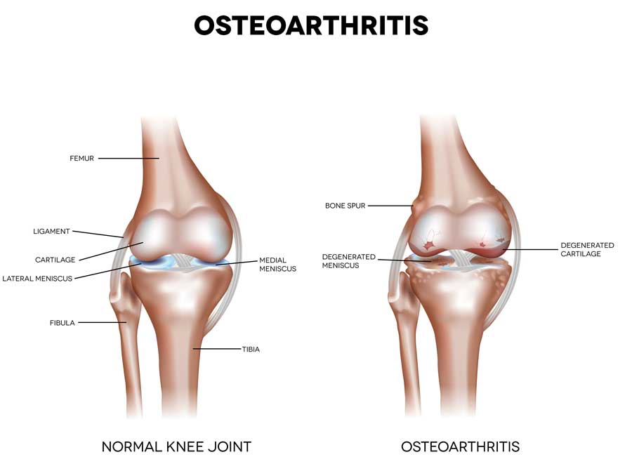 Knee Osteoarthritis Doctor