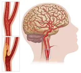 Carotid Artery Disease
